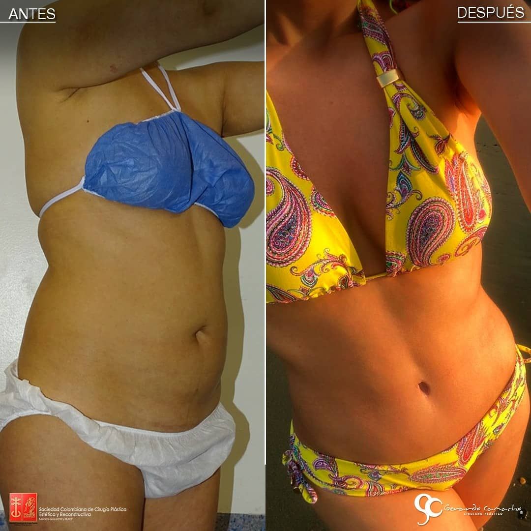 Testimonio Abdominoplastia Gerardo Camacho